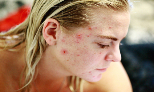 Como eliminar acne agresivo por desintoxicación com Agave